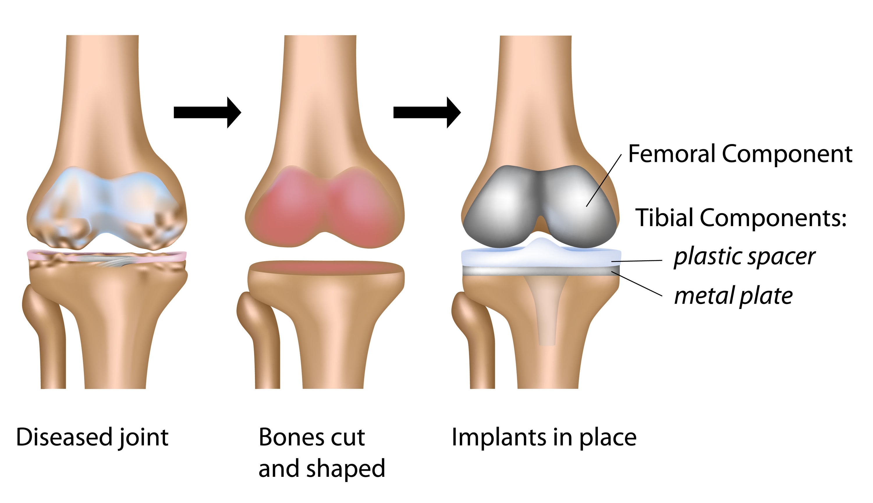 Physio-4 Therapies for Joint Replacement